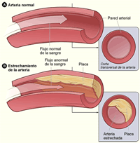 Arteria normal, Estrachamiento de la arteria