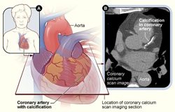 An illustration showing the position of the heart in the body and the location and angle of the coronary calcium scan image and a coronary calcium scan image, which shows calcification in a coronary artery.