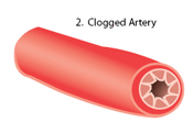 Illustration of a clogged artery.