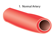 Illustration of a normal artery.