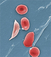 Sickle Cell