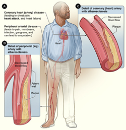 Illustration showing how smoking can affect arteries in the heart and legs. Figure A shows the location of coronary heart (artery) disease and peripheral arterial disease. Figure B shows a detailed view of a leg artery with atherosclerosis—plaque buildup that's partly blocking blood flow. Figure C shows a detailed view of a coronary (heart) artery with atherosclerosis